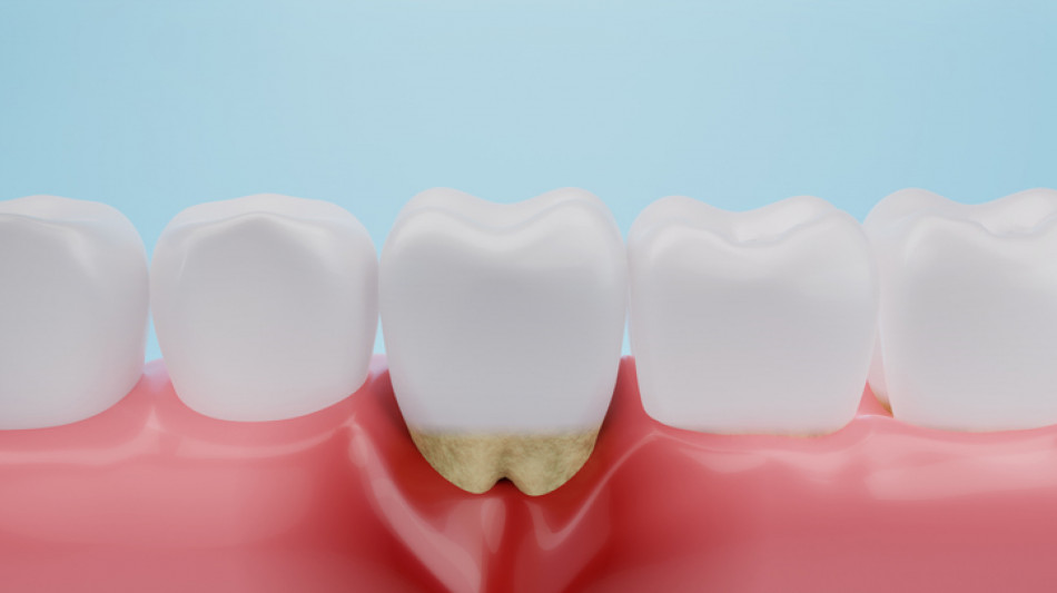 Parodontite legata a aritmie,le cure dentali riducono il rischio